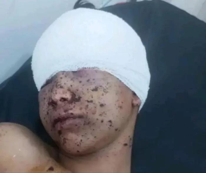 فقدان طفل لإحدى عينيه إثر قصف حوثي على حي سكني في تعز